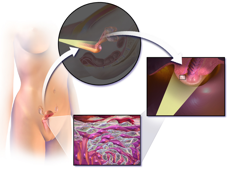 Kolposkopiya nedir ve niye vacibdir?