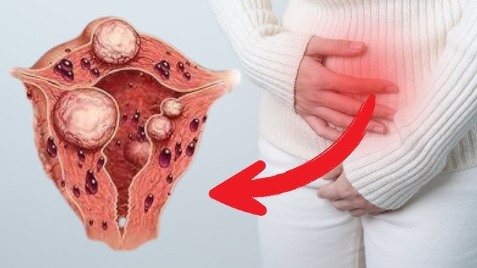 Adenomioz zamani hamile qalmaq olarmi?