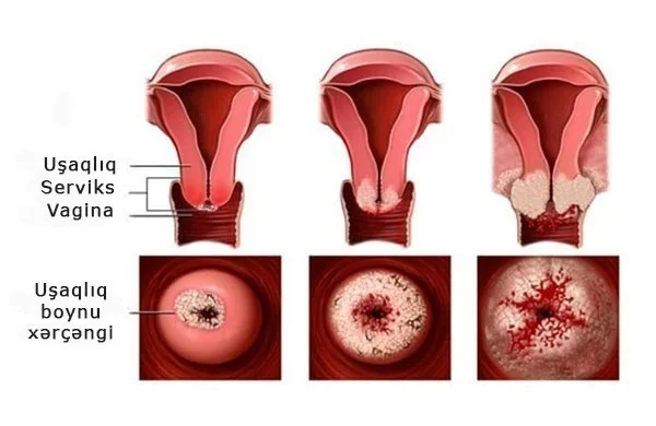 Usaqliq boynu xercengi nedir? Elametleri ve mualicesi