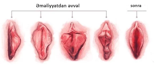 Labioplastika nedir? Cinsiyyet dodaqlarinin estetikasi