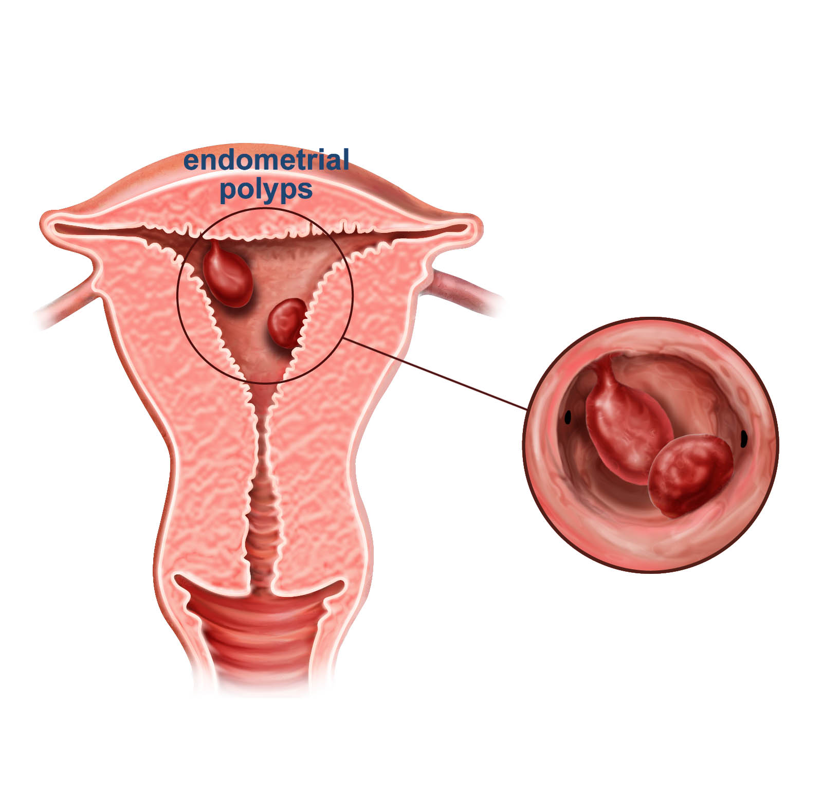 Polip nedir?
