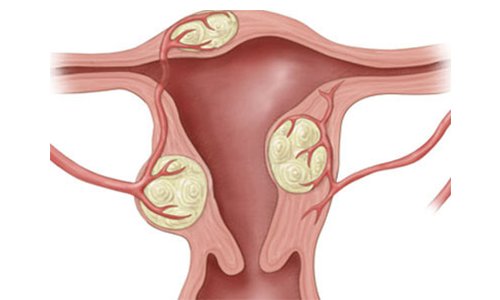 Mioma (fibroma) nedir? Nece yaranir ve mualicesi