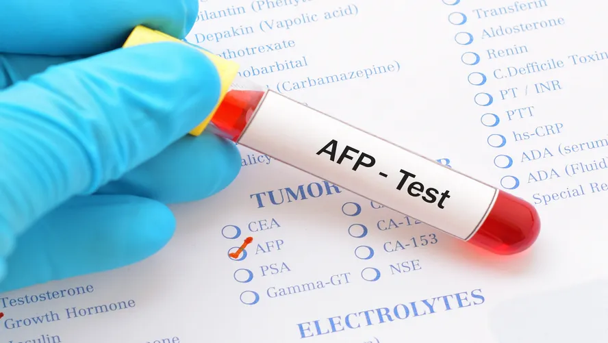 AFP (Alfa feto protein) yuksekliyi